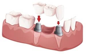 dental bridge illustration