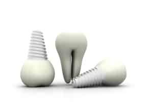 dental implants and restorations