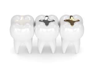 dental filling options