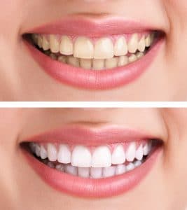 teeth whitening results