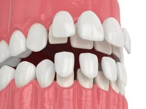 porcelain veneers