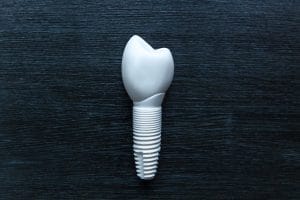 dental implant restoration