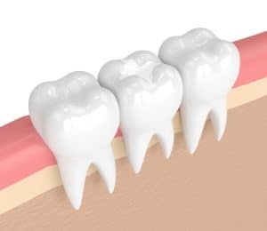 houston dental fillings