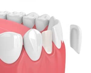 houston porcelain veneers