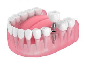 houston dental implants