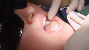 houston dental fillings