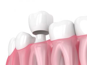 houston dental crowns