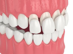 houston porcelain veneers