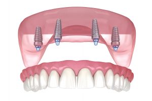 houston implant dentures