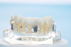 houston dental implants