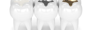 houston dental fillings