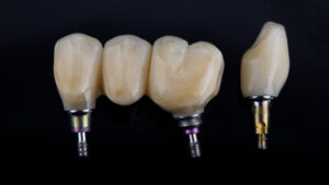 houston dental bridge