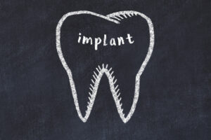 houston dental implants