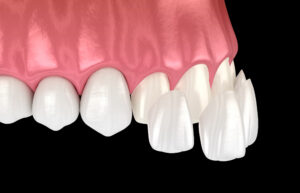 houston porcelain veneers