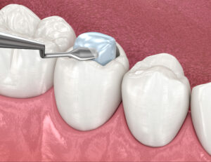 houston dental filling